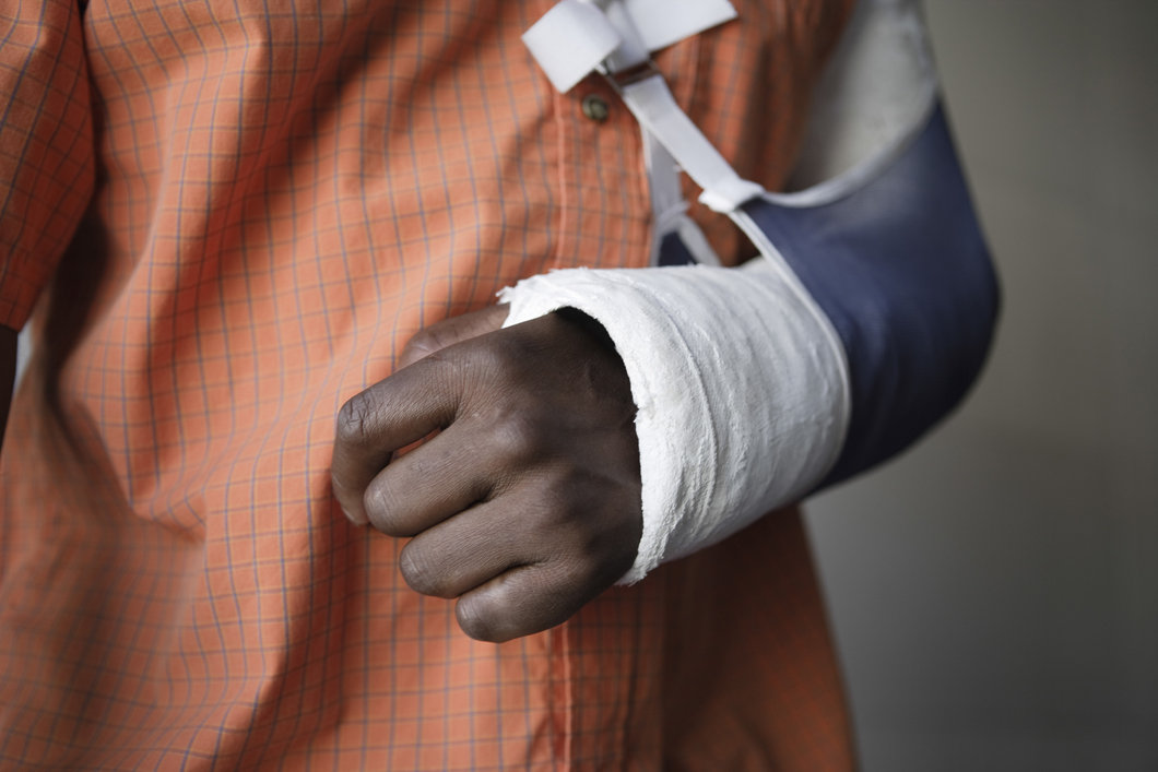 A person with a broken arm and cast on their hand.