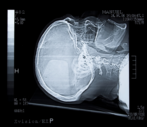 A picture of an x-ray image of the knee.